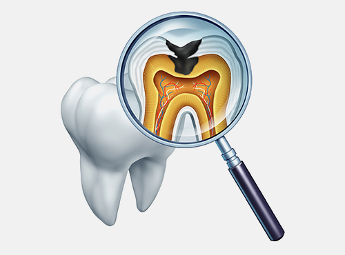 進行した虫歯の治療で歯を長持ちさせる
