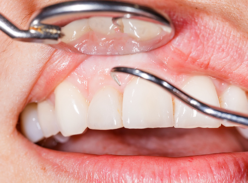 歯を失う原因第一位は歯周病